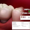 OHI-S Implantation Without Peri-Implantitis