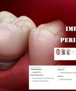 OHI-S Implantation Without Peri-Implantitis