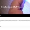 Ovate Pontics and Soft Tissue