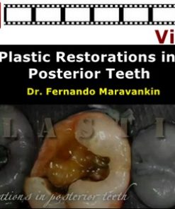 Plastic Restorations in Posterior Teeth (Video)