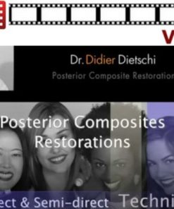 Posterior Composites Restorations