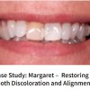 Margaret –  Restoring Tooth Discoloration and Alignment 