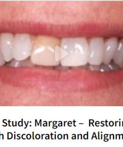 Margaret –  Restoring Tooth Discoloration and Alignment 