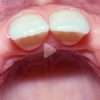 Single Tooth Anterior Implants