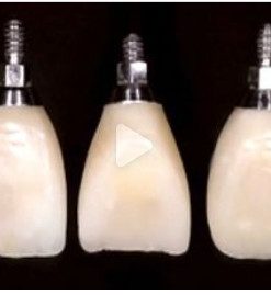 Single Tooth Implant Temporaries