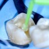 Baard Immediate Dentin Sealing & Advanced Adhesion for Indirects
