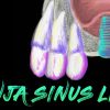 Sinus Lifting Master