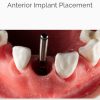 Anterior Implant Placement