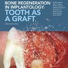 Bone regeneration in implantology