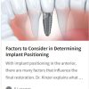 Factors to Consider in Determining Implant Positioning