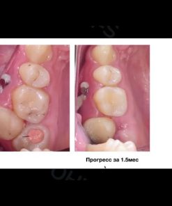 International experience of treatment with the DAMON system