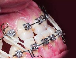 Signs indicating for orthodontic treatment