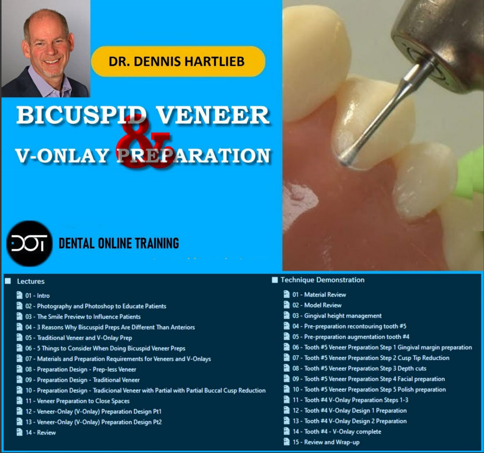 Bicuspid Veneer & V-Onlay Preparation - Dennis Hartlieb