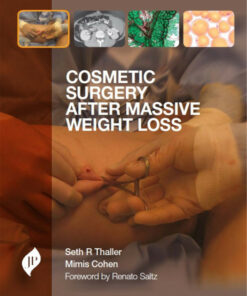 Cosmetic Surgery After Massive Weight Loss 1st Edition
