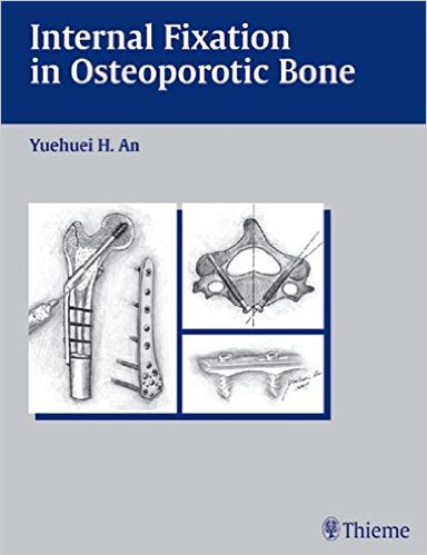 Internal Fixation in Osteoporotic Bone 1st Edition