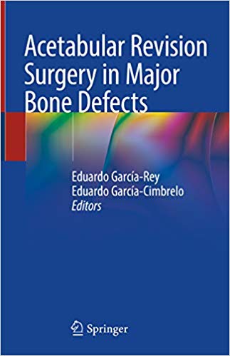 Acetabular Revision Surgery in Major Bone Defects 1st ed. 2019 Edition