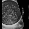 1637743367 1310793428 imaging mastery series high risk screening breast mri 2021.jpg