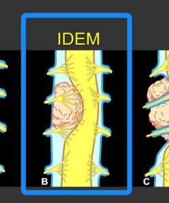 MRI Mastery Series: Intradural Extramedullary Lesions (IDEM) 2020