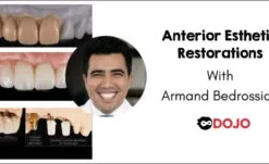 Anterior Implant Esthetic Restorations