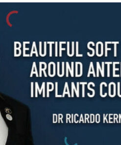 Beautiful Soft Tissue Around Anterior Implants