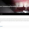 Cementing Porcelain Veneers.jpg