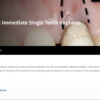 Immediate Single Tooth Implants.jpg