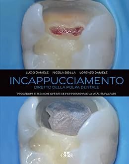 Incappucciamento diretto della polpa dentale: Procedure e tecniche operative per preservare la vitalità pulpare / Lucio Daniele, Nicola Sibilla, Lorenzo Daniele (2023)