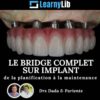 LearnyLib Le Bridge Complet sur Implant.jpg