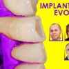 OHI S Implant Perio Evolution.jpg