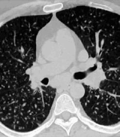 Imaging Mastery Series: Micronodules 2021 cme videos