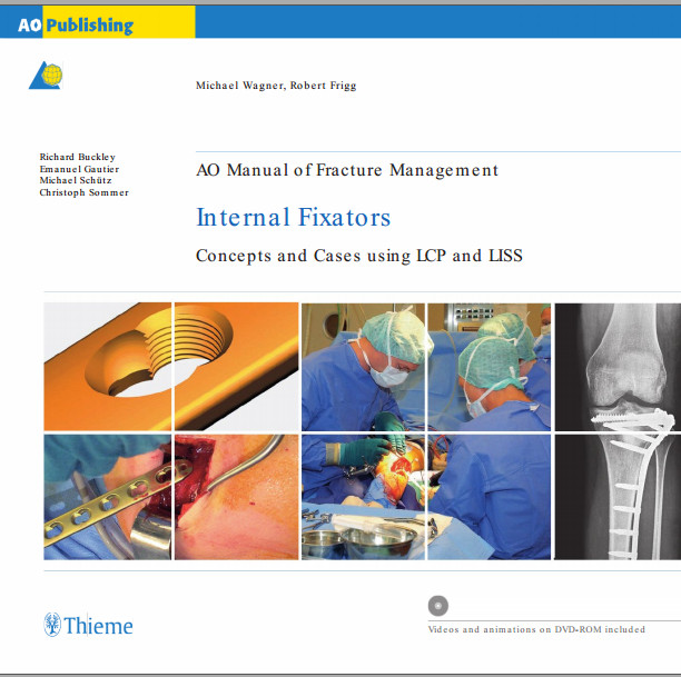 AO Manual of Fracture Management: Internal Fixators: Concepts and Cases using LCP/LISS AO Manual of Fracture Management: Internal Fixators: Concepts and Cases using LCP/LISS