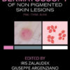 Dermatoscopy of Non-Pigmented Skin Tumors: Pink – Think – Blink