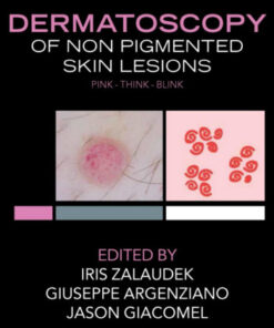 Dermatoscopy of Non-Pigmented Skin Tumors: Pink – Think – Blink