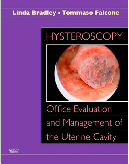 Hysteroscopy: Office Evaluation and Management of the Uterine Cavity: Text 1e Hysteroscopy: Office Evaluation and Management of the Uterine Cavity: Text 1e
