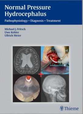 NPH – Normal Pressure Hydrocephalus: Pathophysiology – Diagnosis – Treatment 1st edition NPH – Normal Pressure Hydrocephalus: Pathophysiology – Diagnosis – Treatment 1st edition