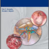Cholesteatoma Cholesteatoma