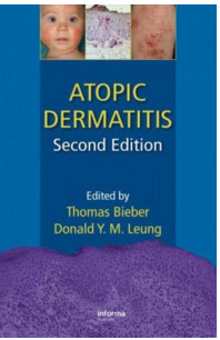 Atopic Dermatitis Atopic Dermatitis