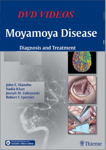 Moyamoya Disease: Diagnosis and Treatment – Original PDF + Videos Moyamoya Disease: Diagnosis and Treatment – Original PDF + Videos