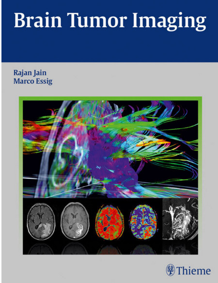 Brain Tumor Imaging 1st Edition Brain Tumor Imaging 1st Edition