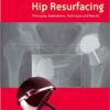 Hip Resurfacing: Principles, Indications, Technique and Results 1e Hip Resurfacing: Principles, Indications, Technique and Results 1e