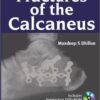 Fractures of the Calcaneus 1 Har/Dvdr Edition Fractures of the Calcaneus 1 Har/Dvdr Edition