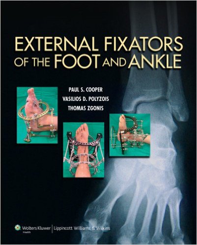 External Fixators of the Foot and Ankle 1st Edition External Fixators of the Foot and Ankle 1st Edition