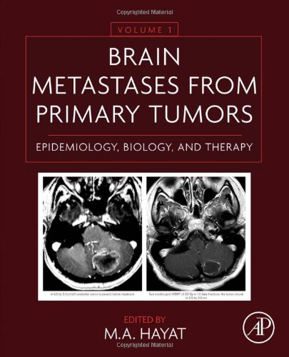 Brain Metastases from Primary Tumors. Epidemiology, Biology, and Therapy Volume 1 Brain Metastases from Primary Tumors. Epidemiology, Biology, and Therapy Volume 1