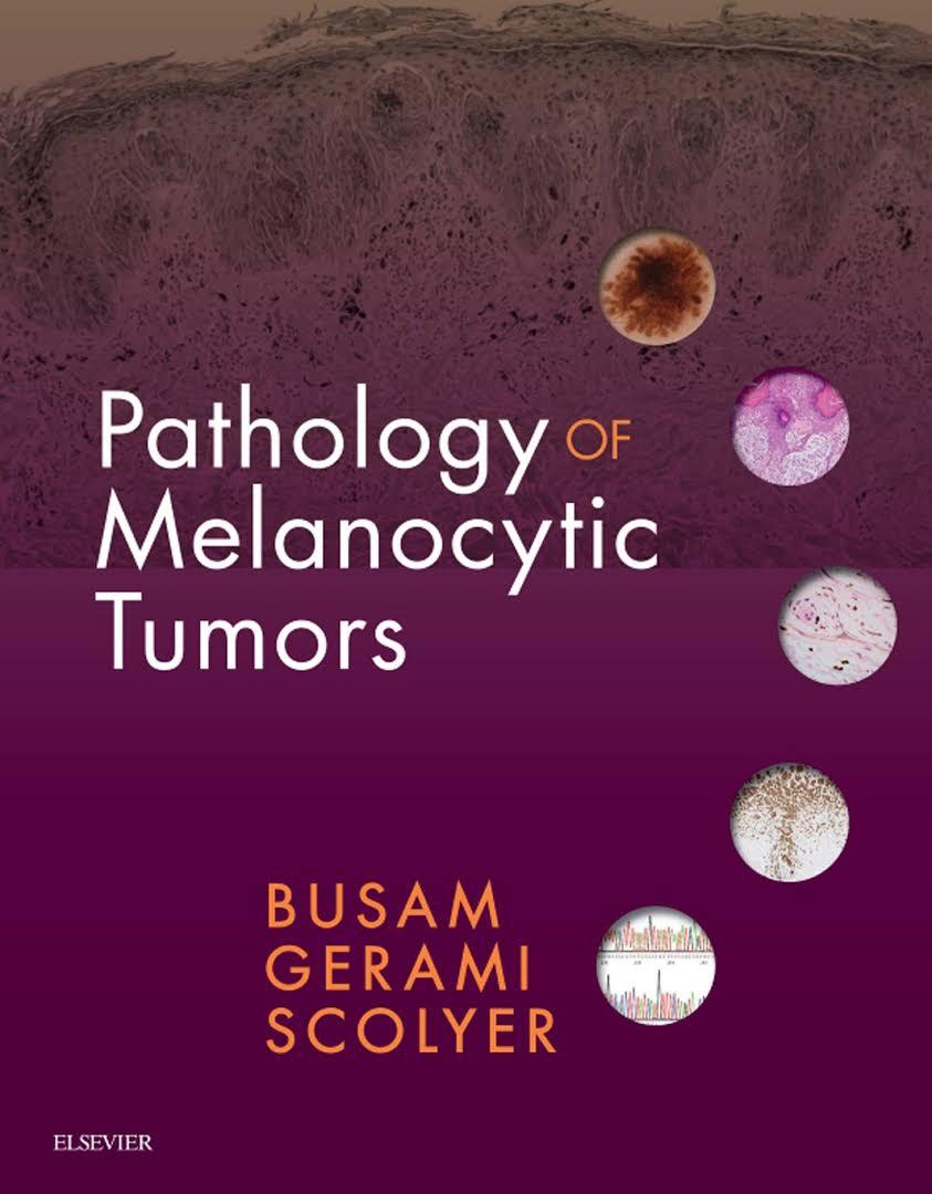 Pathology of Melanocytic Tumors Pathology of Melanocytic Tumors