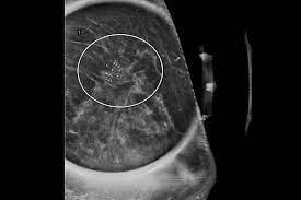 Imaging Mastery Series: High Risk Screening Breast MRI 2021