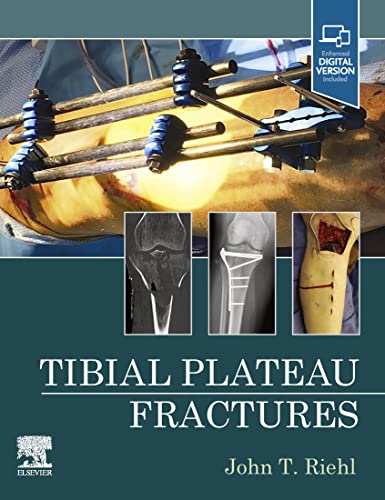 Tibial Plateau Fractures 1st Edition PDF Original Tibial Plateau Fractures 1st Edition PDF Original