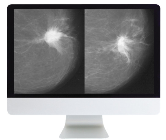 Harmonizing Breast Cancer Screening Recommendations Hybrid Course
