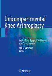Unicompartmental Knee Arthroplasty Indications, Surgical Techniques and Complications 2020 Original pdf Unicompartmental Knee Arthroplasty Indications, Surgical Techniques and Complications 2020 Original pdf