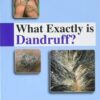 What Exactly is Dandruff Original PDF What Exactly is Dandruff Original PDF