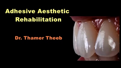 Video Dental Adhesive Aesthetic Rehabilitation